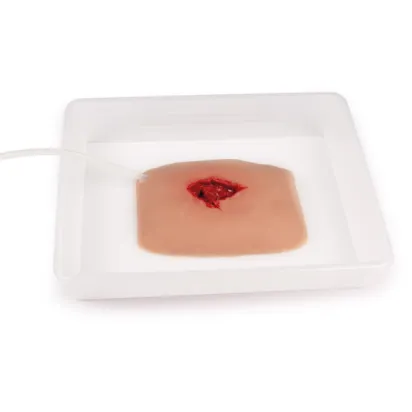 Wundmoulage Wound Packing